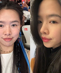这方法能一次性解决泪沟,黑眼圈,细纹