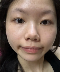 用我的纯素颜变化来告诉你,做祛斑必须要知道的那些事