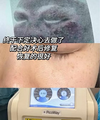 用我的纯素颜变化来告诉你,做祛斑必须要知道的