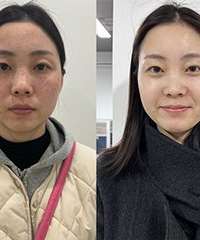 祛斑后的皮肤完全变了,人都自信了