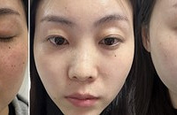祛斑之后,人都自信起来了!做3次就有这个效果
