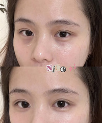 780元就搞定了黑眼圈和泪沟,说说我的嗨体1.0真实感受
