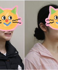 矫正牙齿比想象中还快,这是8个月的变化!嘴都不凸了