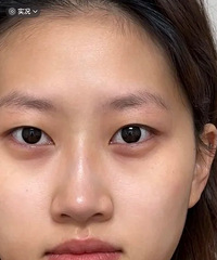 没想到纹眉也可以改善太阳穴凹陷,简直花小钱办大事