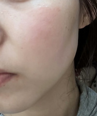 脸上有炎症,总是红红的,怎样才能真正消除?都来说说方法