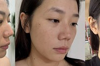 综合祛斑的方法,真的很有效!皮肤变得很干净