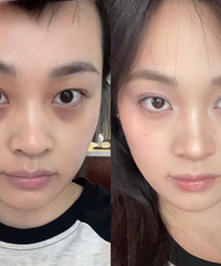 这个去黑眼圈的方法,我要强烈分享给大家!效果太明显了