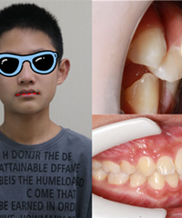 分享娃的牙齿矫正过程,终于改善好了