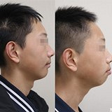 矫正牙齿后的面部变化