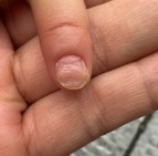 小朋友左手食指变形