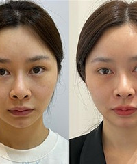 快速淡化眼纹和黑眼圈的方法,我选这个