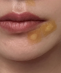 [����]Ƥ������֢������������������˵����������ˮ�ͺ���