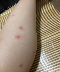 丘疹性荨麻疹?季节性过敏?螨虫叮咬?