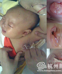 "杭州女婴接种卡介苗患上淋巴结核 80后教师求大家救救女儿{转的}