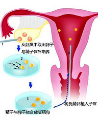 "试管婴儿过程"