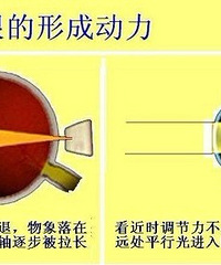 "近视形成的原因"