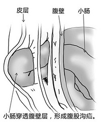 "腹股沟旁鸽子蛋大的肿块忽隐忽现原来是得了疝气 "