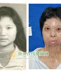 夫妻吵架妻子被汽油烧伤 十余年后借整形挽回婚姻(图)