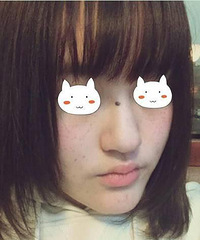 "光子嫩肤祛斑!来看看效果吧~"