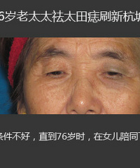 杭州76岁老太刷新整容记录