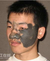 时光美丽援助黑鼻少年祛巨痣