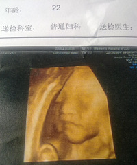 "鉴定宝宝多半是男孩,27周+2天 发现脐带绕颈一周"