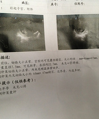 "怀孕60多天,被医院直接判死刑,胚胎不好难免流产我这样还有希望吗