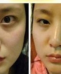 韩式双眼皮&假体隆鼻跟姐妹们一样一路担心过来的~