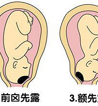 "胎位不正怎么纠正"