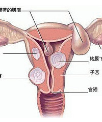 "治疗子宫肌瘤的N多碎碎念"