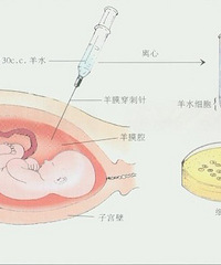 "羊水穿刺风险大不大?"