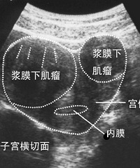 子宫出血 ,别担心,及时就医