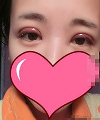 做完双眼皮手术后自己感觉很不错。。