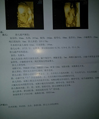 四维彩超归来