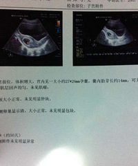 "52天健康胎心胎芽,接了必沾好孕!清宫后内膜薄,排卵早,卵泡小