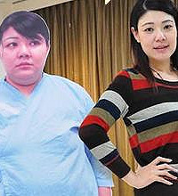 女子做缩胃手术一年半减54公 变美女