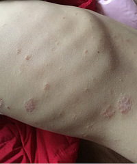 我女儿现在三周岁了,从出生就开始长湿疹,