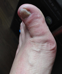 【健康日记】突如其来的感染,让我手足无措