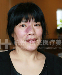 "时光整形联手《小强热线》救助妈妈祛除红脸胎记"