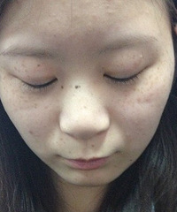 痂终于掉了,带宝宝真不容易