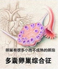 "多囊卵巢综合症是怎么回事?该怎么治疗?"