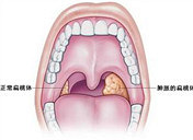 孩子扁桃体和腺样体大,要手术吗