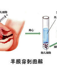 "羊水穿刺疼吗?过几天就要做了~"