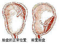 "胎盘前置是什么意思?有什么危害?"
