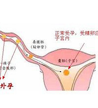 "宫外孕什么时候能发现?"