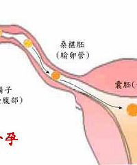 "试纸能测出宫外孕吗?"