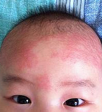 "湿疹用什么药?患了湿疹要注意什么?"