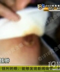 "新手妈妈请月嫂催乳不当得乳腺炎 得了乳腺炎怎么办?"