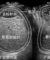 "15岁少女怀上罕见“葡萄胎”: 发生了什么?"
