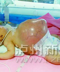 "1月大新生儿腹胀如球 其父拒签手术同意书(图)"